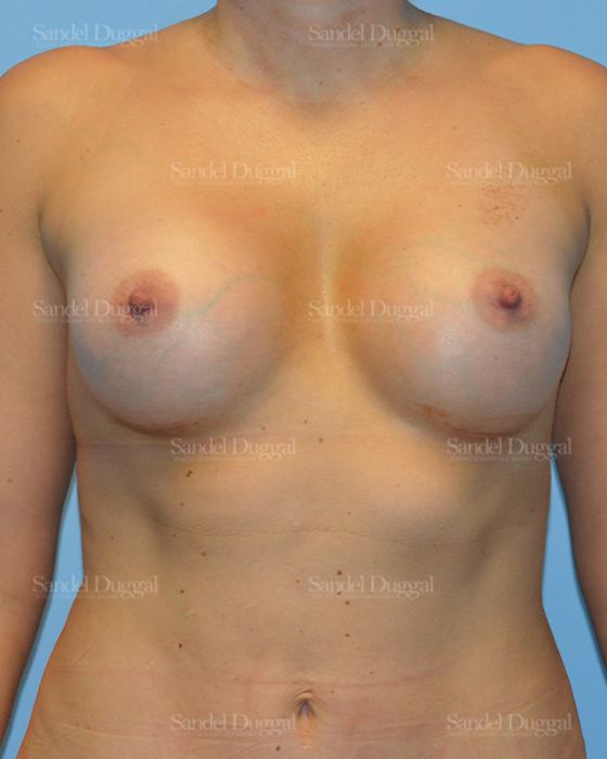 Breast Augmentation after, case 3122