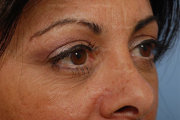 Eyelid Rejuvenation after, case 1922