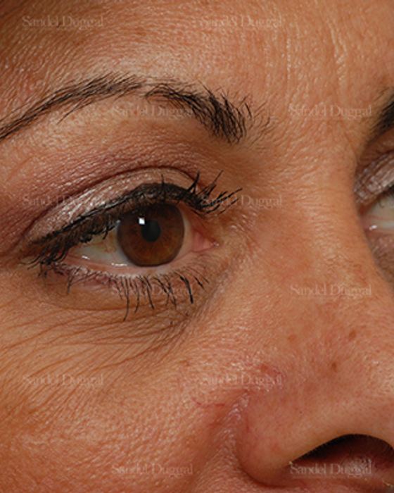 Eyelid Rejuvenation after, case 1922