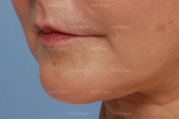 Pre-Jowl Implant after, case 2594