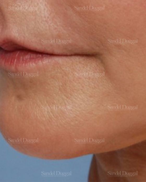 Pre-Jowl Implant after, case 2594