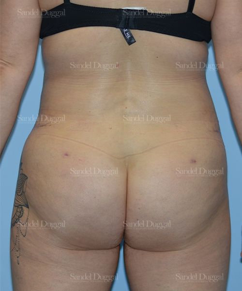 Liposuction — Legs & Flanks after, case 2515
