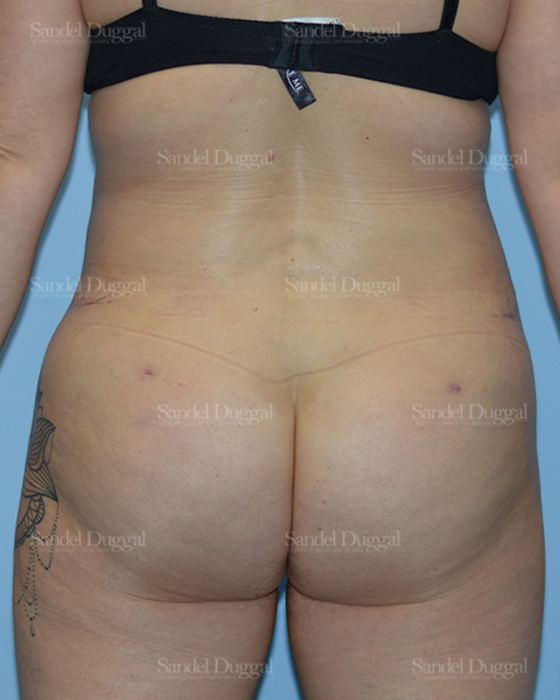 Liposuction — Legs & Flanks after, case 2515
