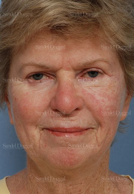 Reconstruction after Mohs after, case 2739