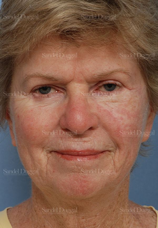 Reconstruction after Mohs after, case 2739