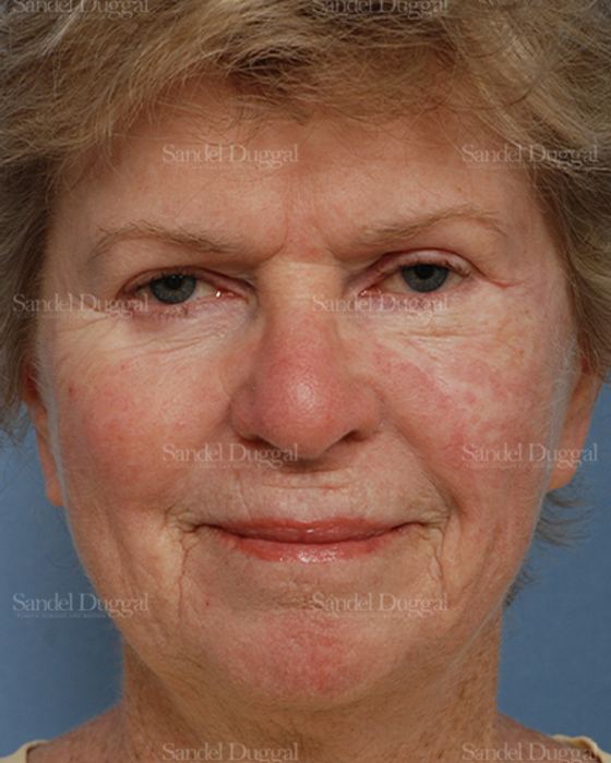 Reconstruction after Mohs after, case 2739