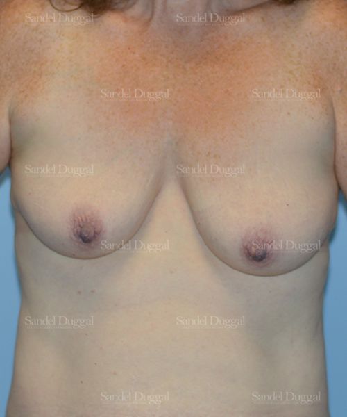 Breast Augmentation with Lift before, case 3365