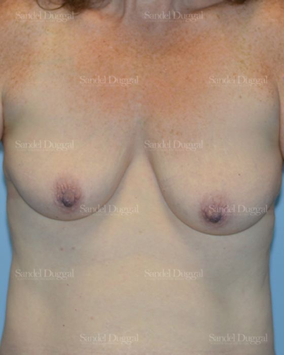 Breast Augmentation with Lift before, case 3365