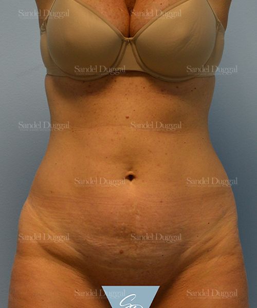 Tummy Tuck before, case 1599