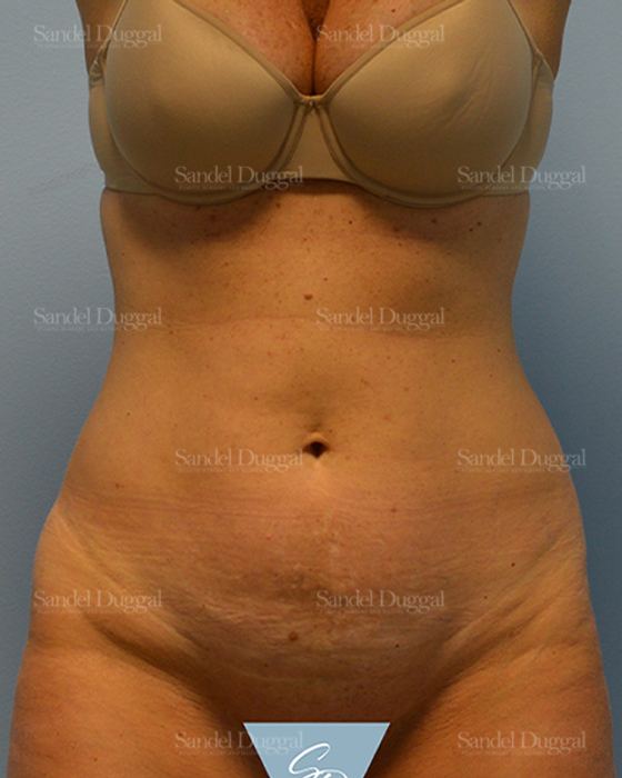 Tummy Tuck before, case 1599