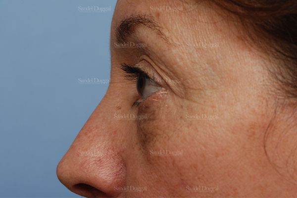 Eyelid Rejuvenation before, case 831