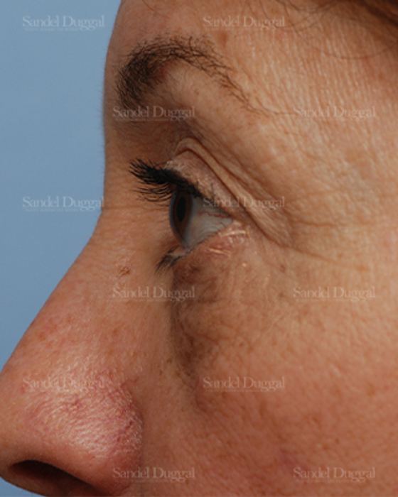 Eyelid Rejuvenation before, case 831