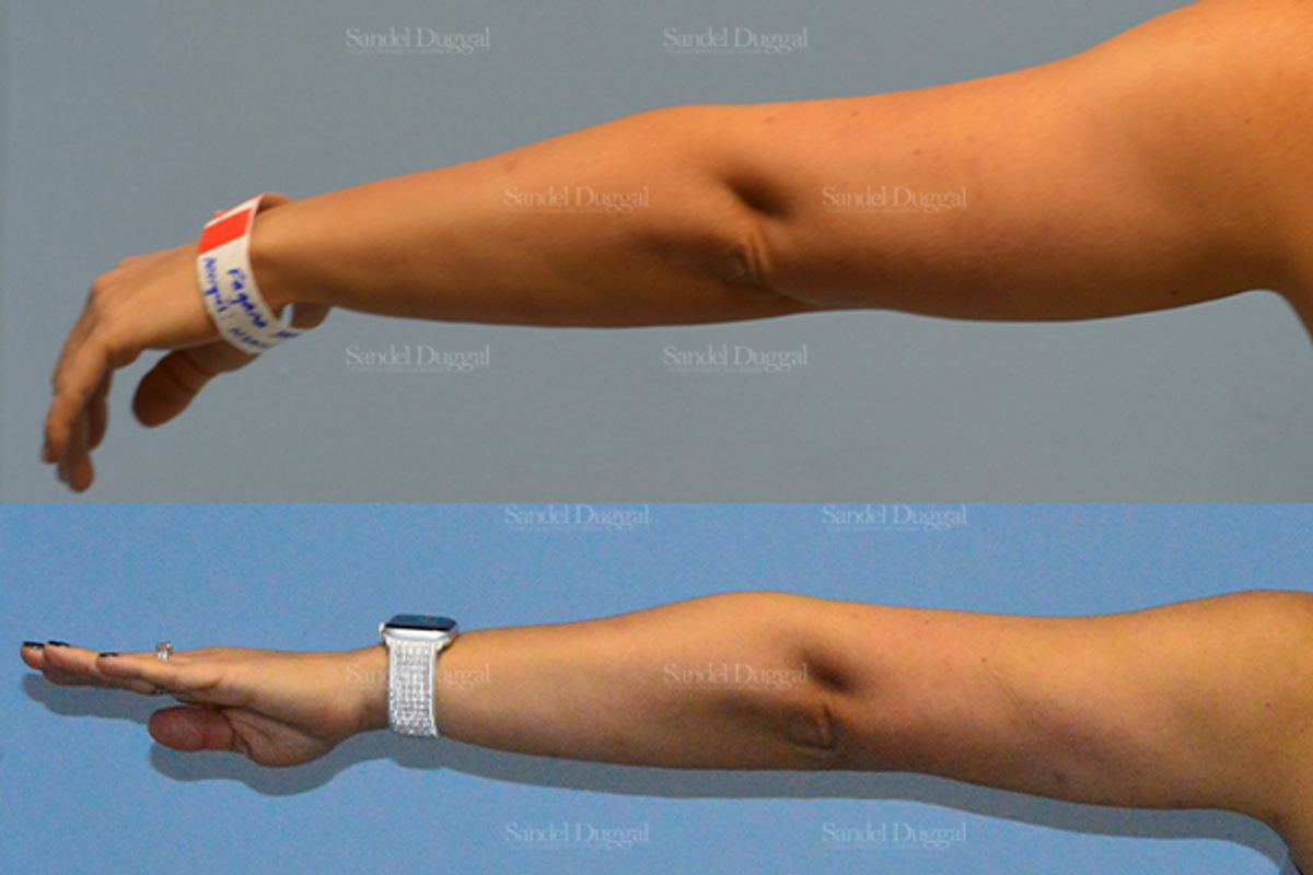 Liposuction — Arms before and after, case 2482