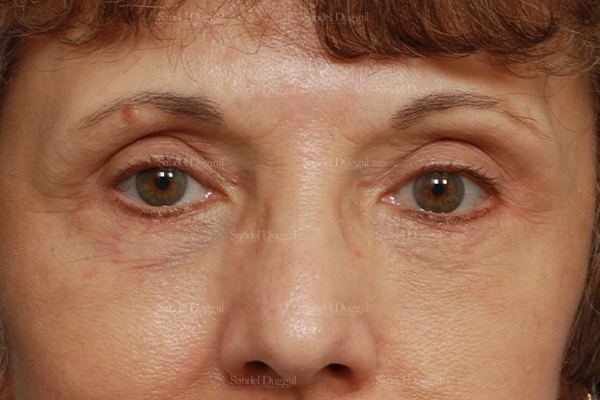 Eyelid Rejuvenation after, case 1907