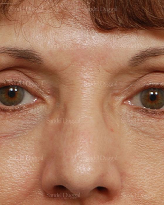 Eyelid Rejuvenation after, case 1907