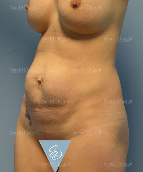 Tummy Tuck before, case 1540