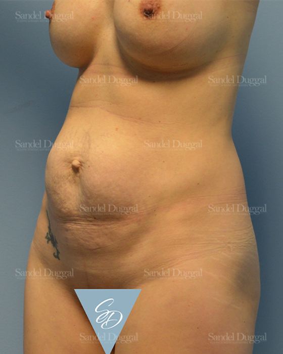Tummy Tuck before, case 1540
