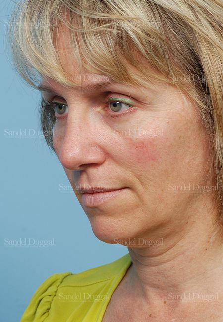 Rhinoplasty after, case 2855