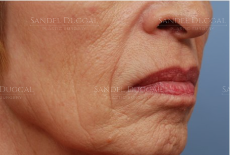 Lower Lip Advancement before, case LLA-2