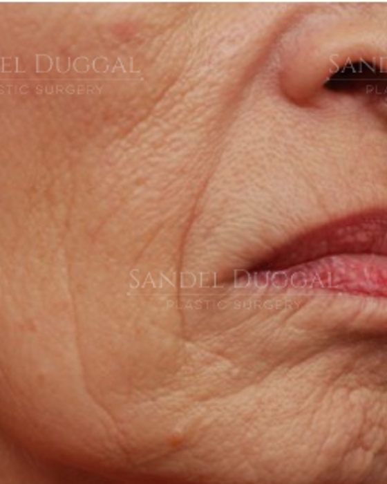 Lower Lip Advancement before, case LLA-2