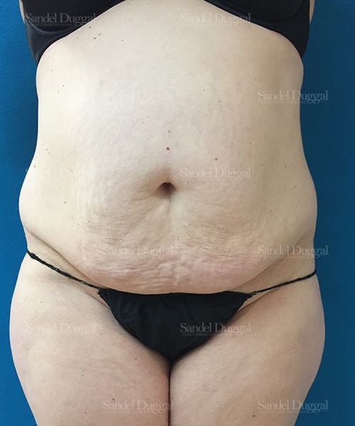 Tummy Tuck before, case 1673