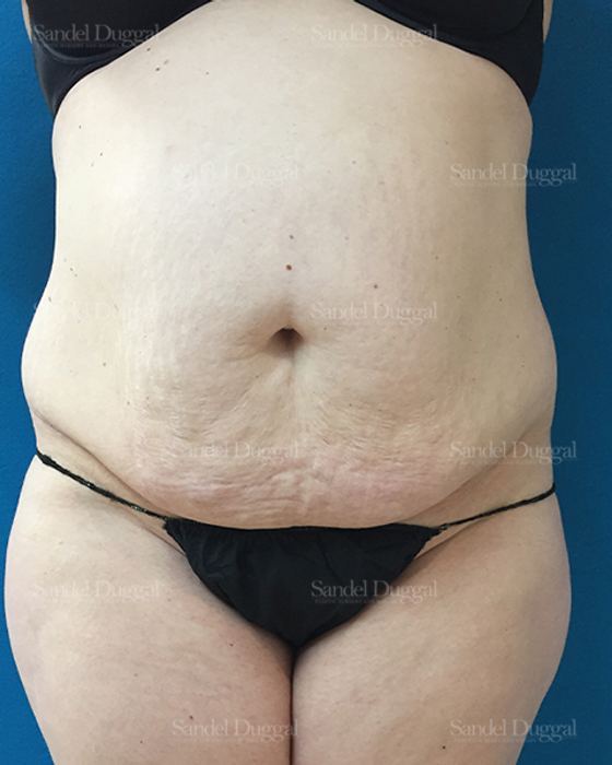 Tummy Tuck before, case 1673