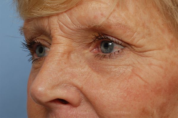 Eyelid Rejuvenation before, case 1946