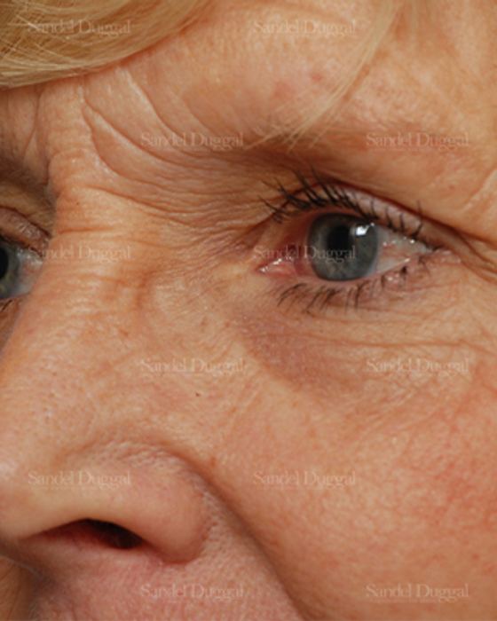 Eyelid Rejuvenation before, case 1946