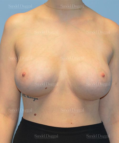 Breast Augmentation after, case 3129