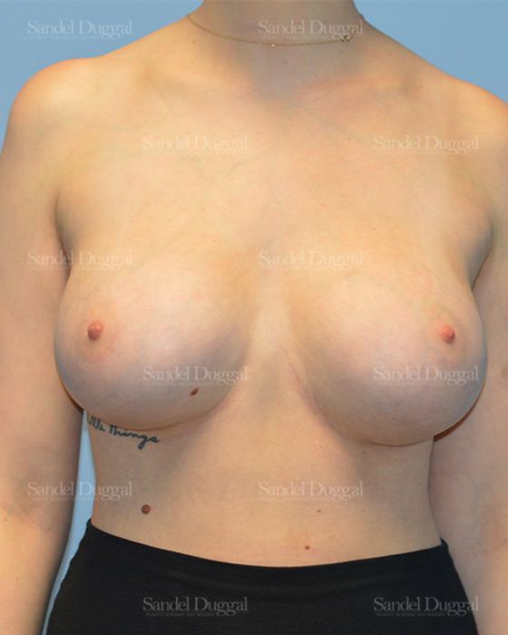 Breast Augmentation after, case 3129