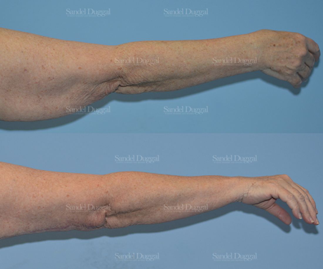 Brachioplasty before and after, case 2113