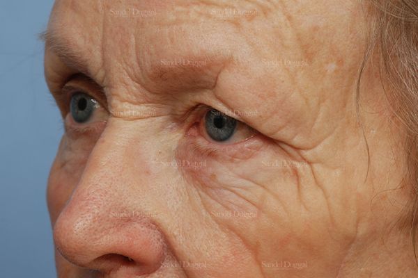 Eyelid Rejuvenation before, case 1951