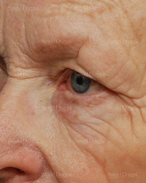 Eyelid Rejuvenation before, case 1951