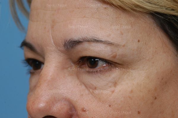 Forehead Lift before, case 2226