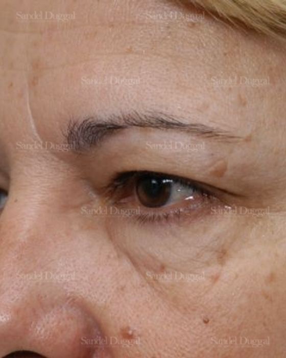 Forehead Lift before, case 2226