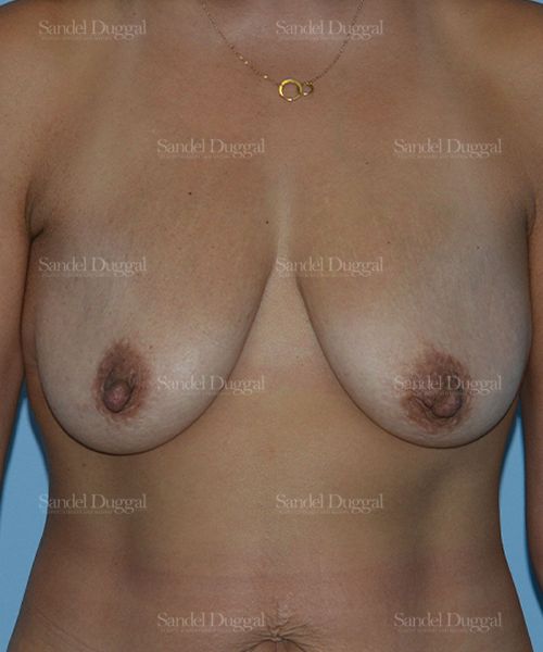 Breast Augmentation with Lift before, case 3449