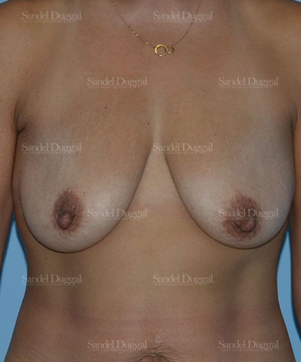 Breast Augmentation with Lift before, case 3449