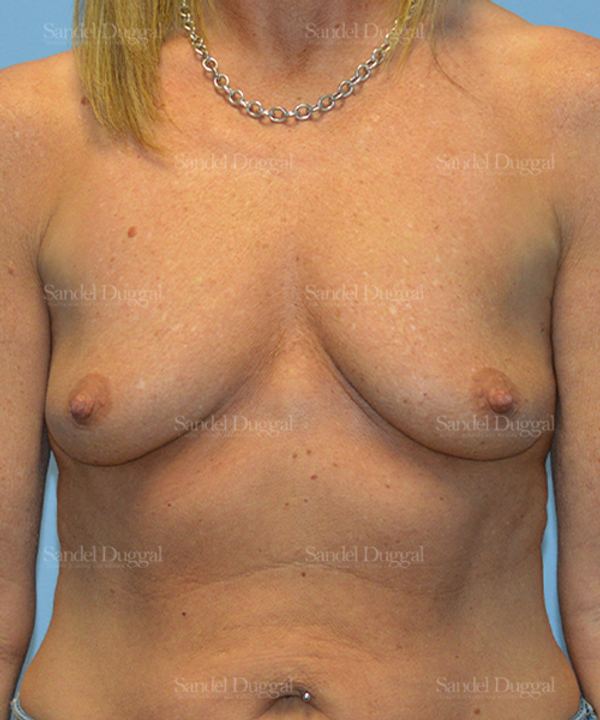 Breast Augmentation with Lift before, case 3386