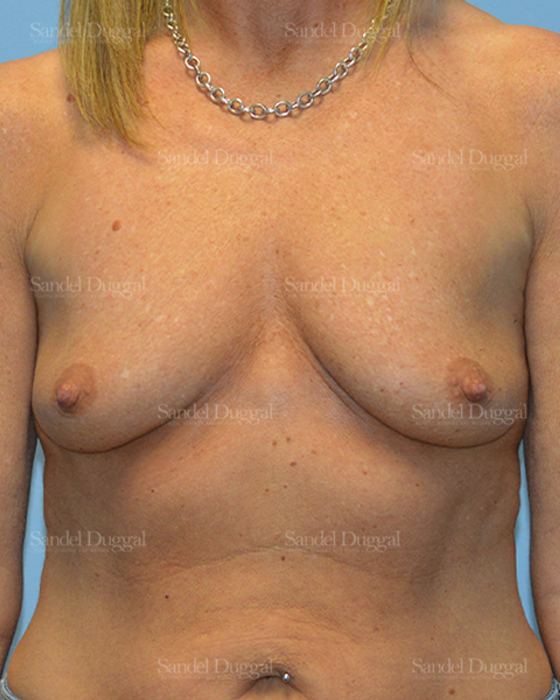 Breast Augmentation with Lift before, case 3386