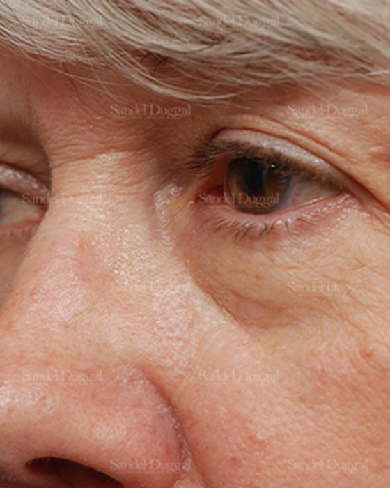 Eyelid Rejuvenation before, case 1983