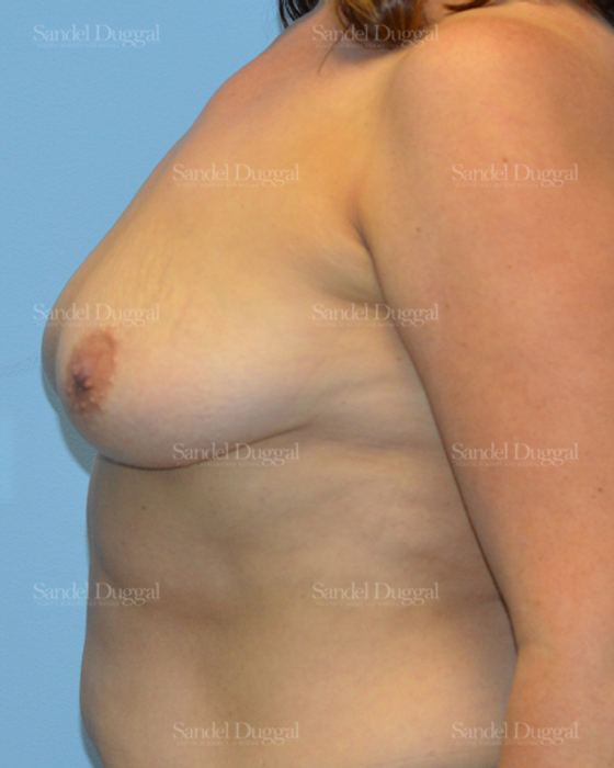 Breast Augmentation before, case 3206