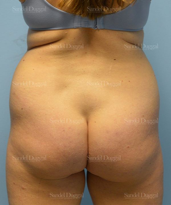 Liposuction — Legs & Flanks before, case 2529