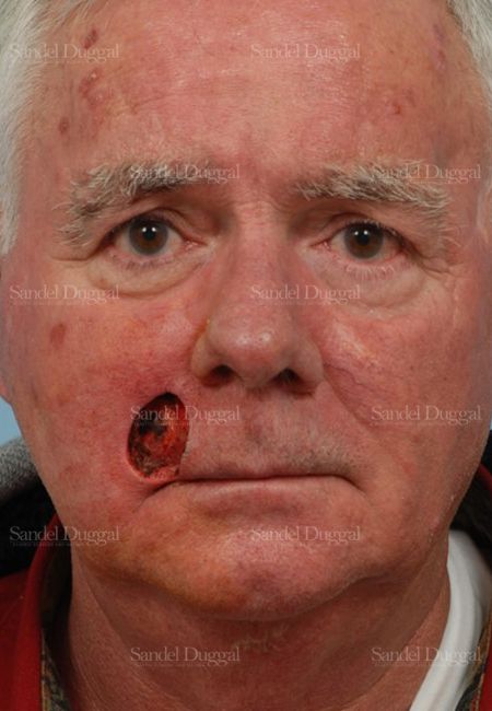 Reconstruction after Mohs before, case 2778