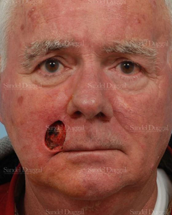 Reconstruction after Mohs before, case 2778