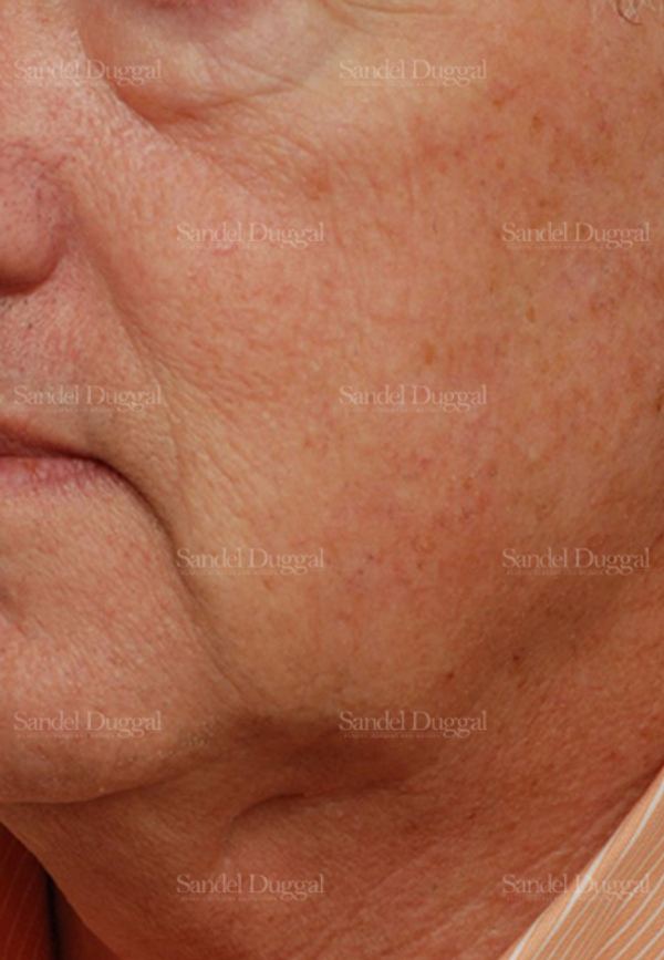 Laser Skin Resurfacing after, case 2926