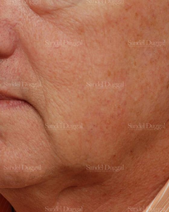 Laser Skin Resurfacing after, case 2926