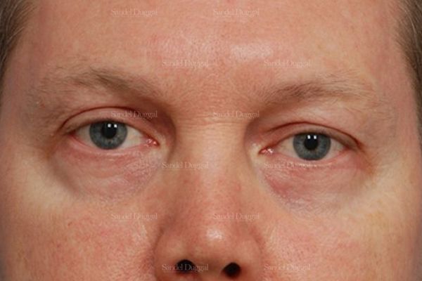 Eyelid Rejuvenation after, case 1965
