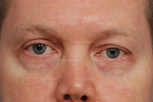 Eyelid Rejuvenation after, case 1965