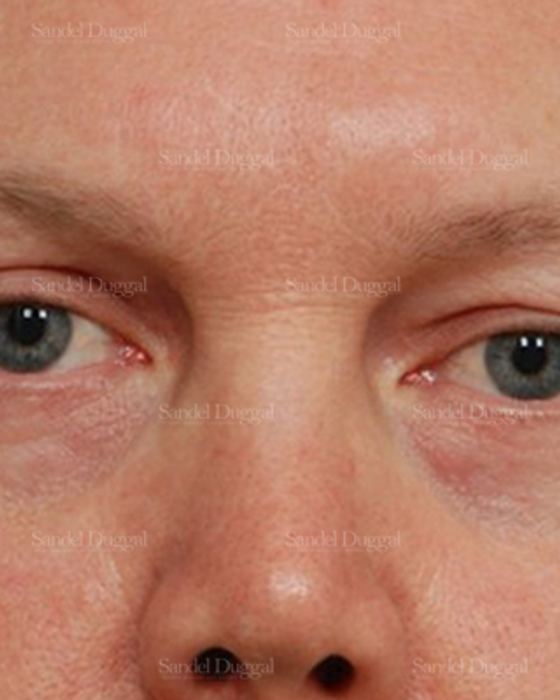 Eyelid Rejuvenation after, case 1965