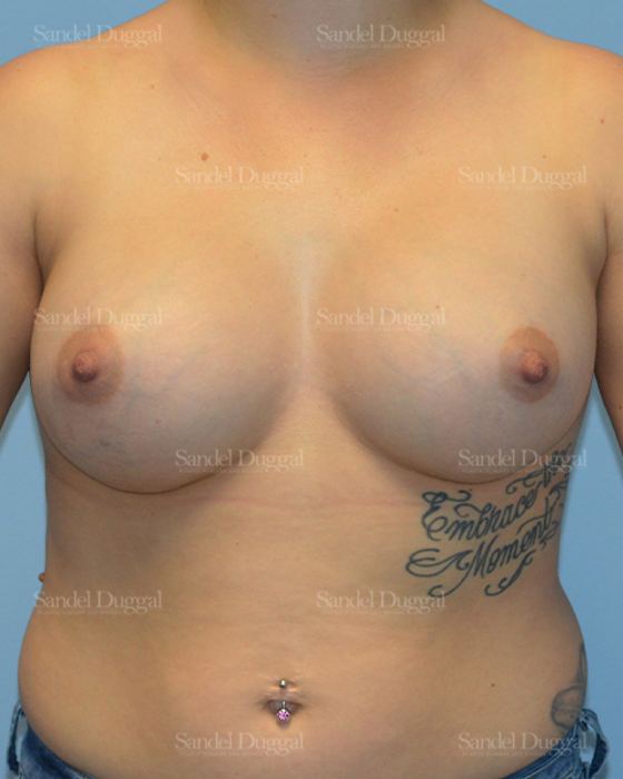 Breast Augmentation after, case 3101